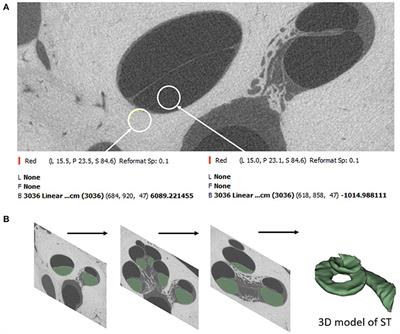Cochlear Size Assessment Predicts Scala Tympani Volume and Electrode Insertion Force- Implications in Robotic Assisted Cochlear Implant Surgery